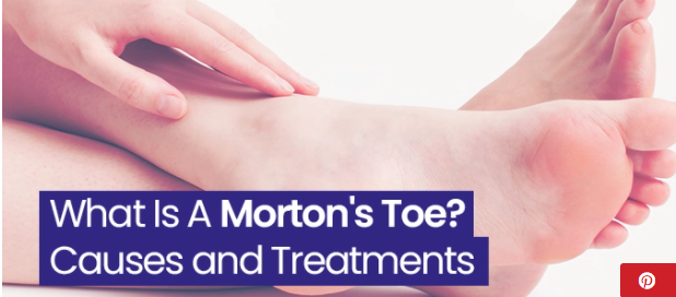 What is Morton's Toe