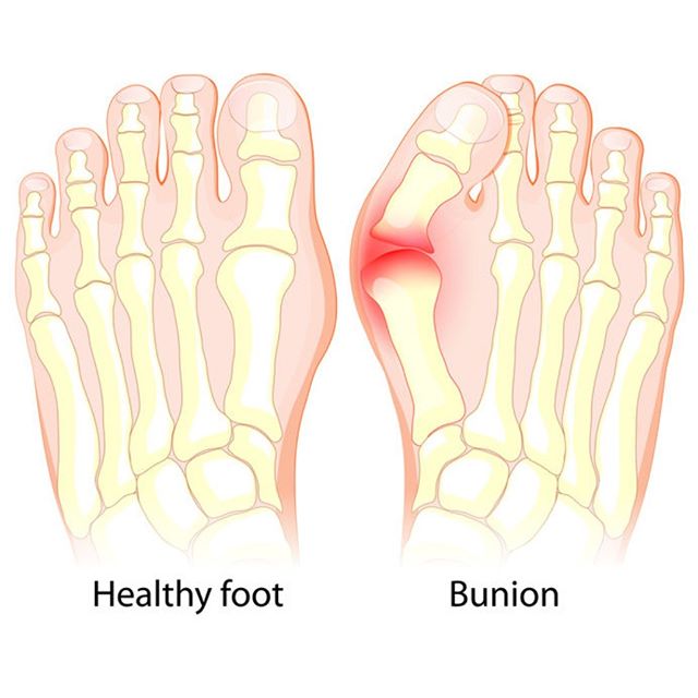 What are BUNIONS?  SYMPTOMS, CAUSES, PREVENTION, AND TREATMENT – Read More here: https://soulinsole.com/bunions-calluses-corns-and-hammer-toes/#bunions#bunions #bunion #bunionsurgery #footpain #soulinsole