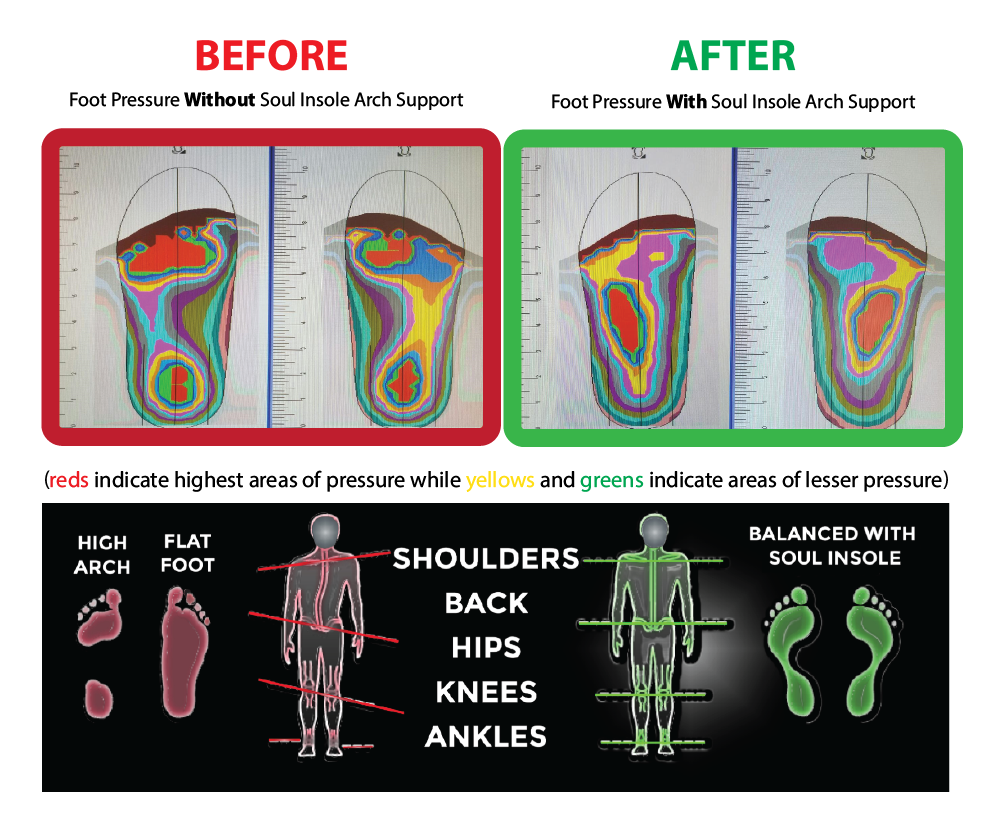 Over Supination vs. Pronation - Soul Insole